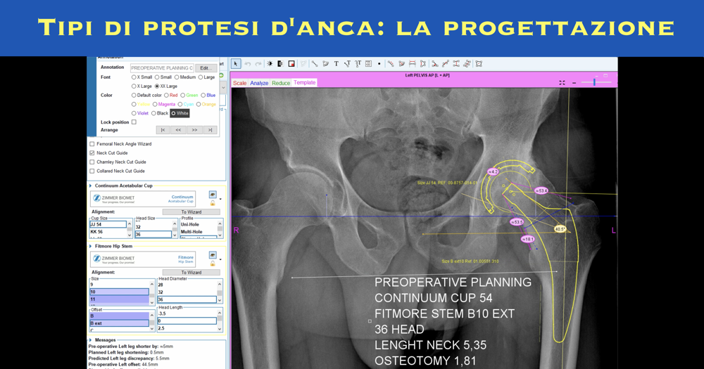 Tipi di protesi danca - la progettazione