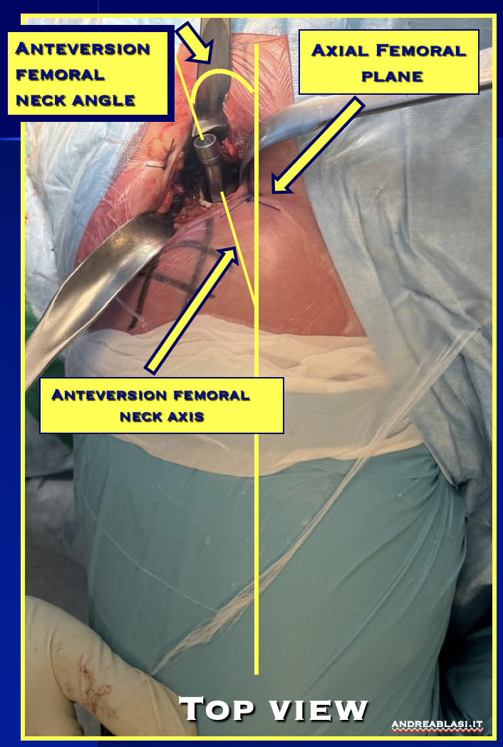 Anteversion evaluation hip replacement