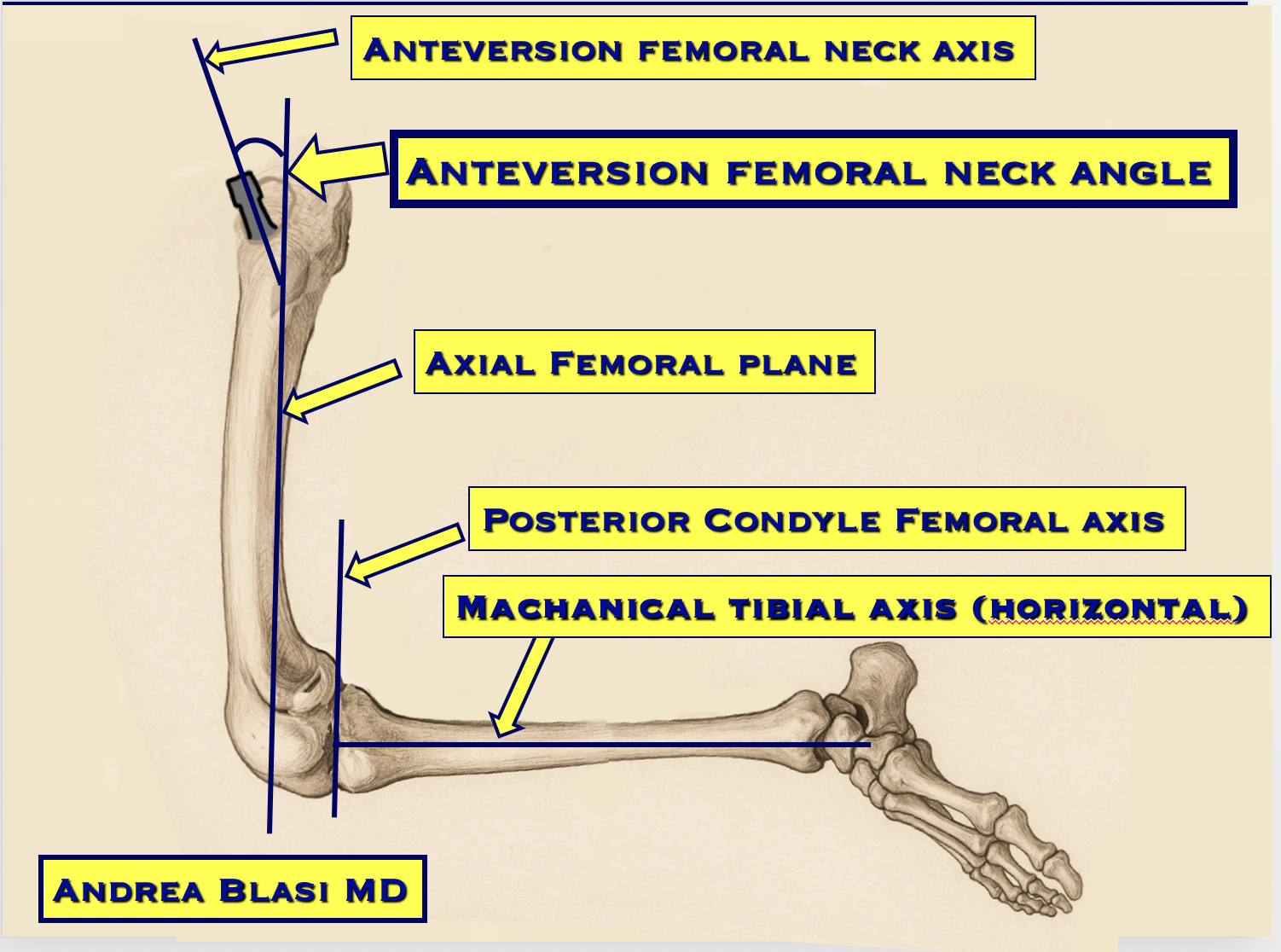 Anteversion femoral neck in hip replacement