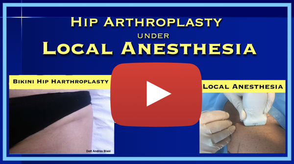 Bikini Hip arthroplasty local anesthesia