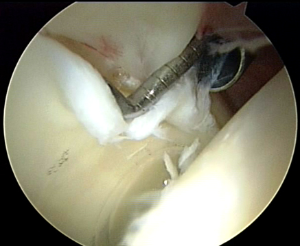 Cartilage delamination