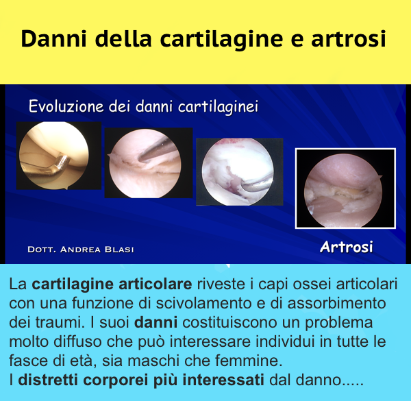 Danni cartilagine e artrosi anca link