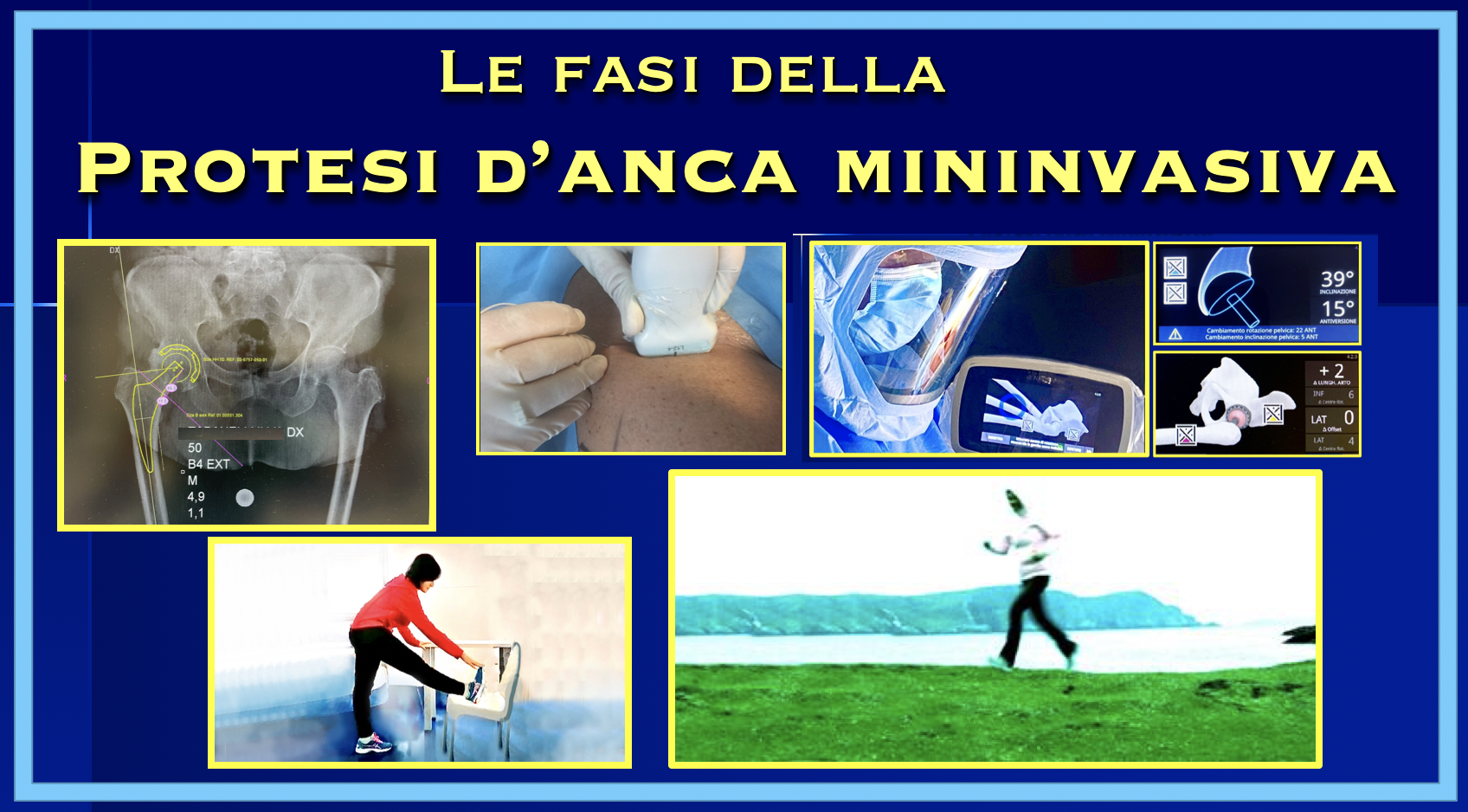 Fasi della protesi danca mininvasiva