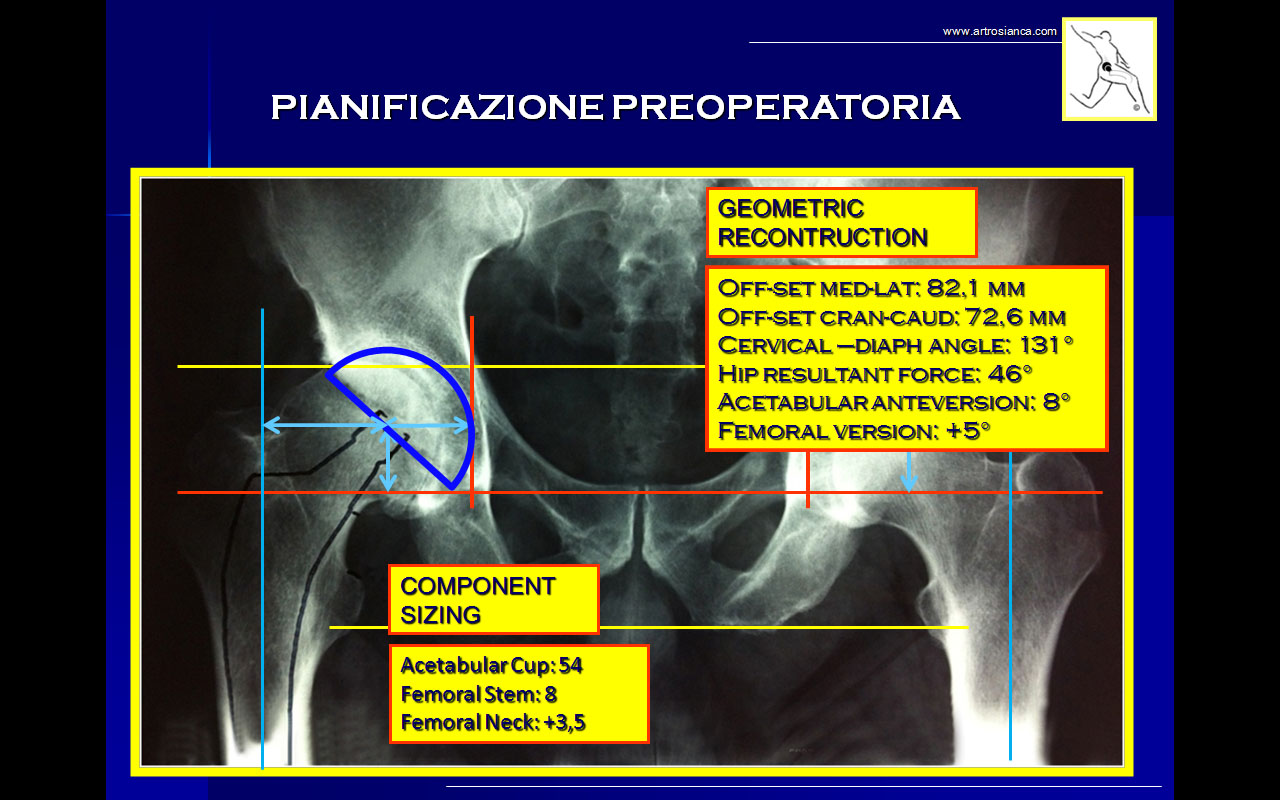 Hip Planning Dott. Blasi