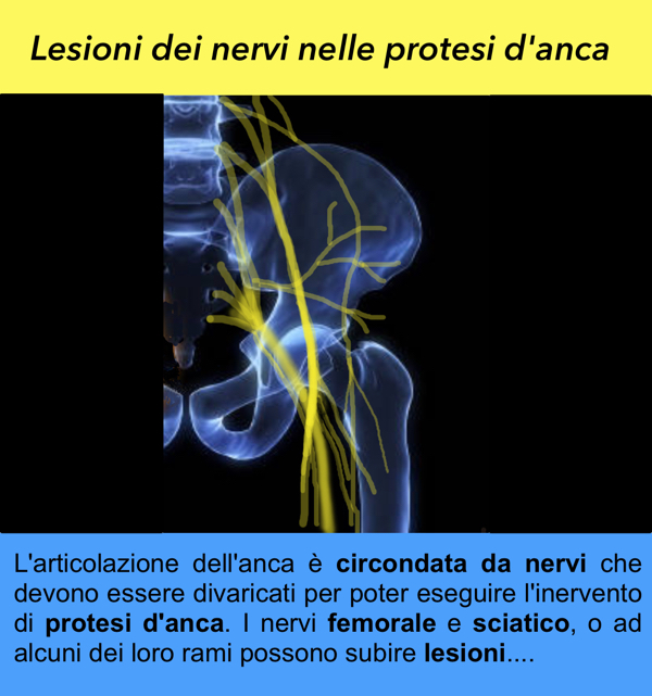 Link Lesione nervi sciatico femorale protesi anca