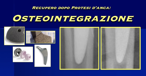 Osteointegrazione recupero dopo protesi anca