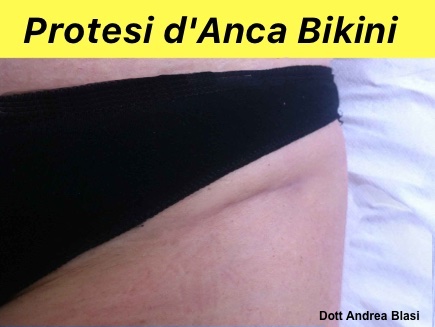 Protesi anca mininvasiva anteriore bikini 2