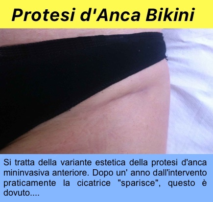 Protesi anca mininvasiva anteriore bikini