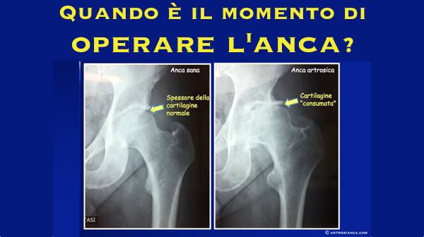 Quando  il momento di operare lanca protesi
