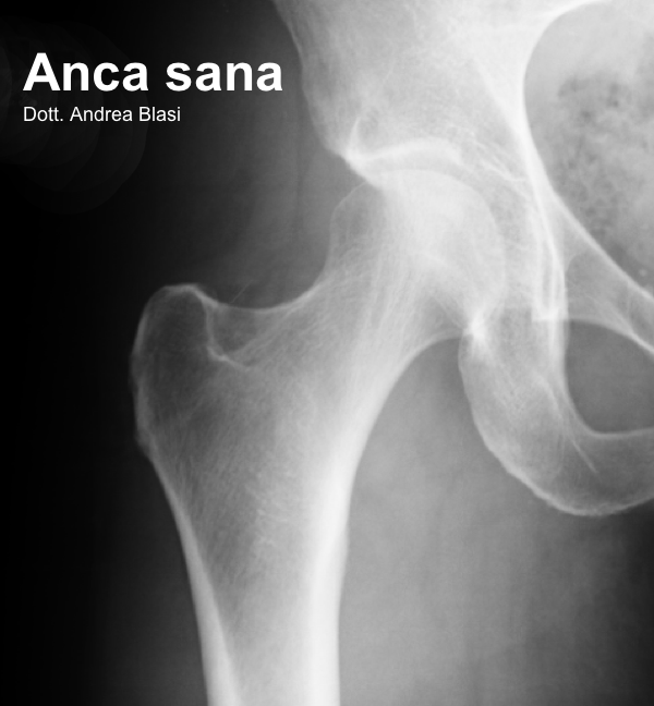 RX anca sana immagine radiografica dott andrea blasi