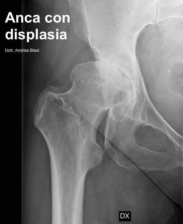 Rx Displasia anca e artrosi dott andrea blasi