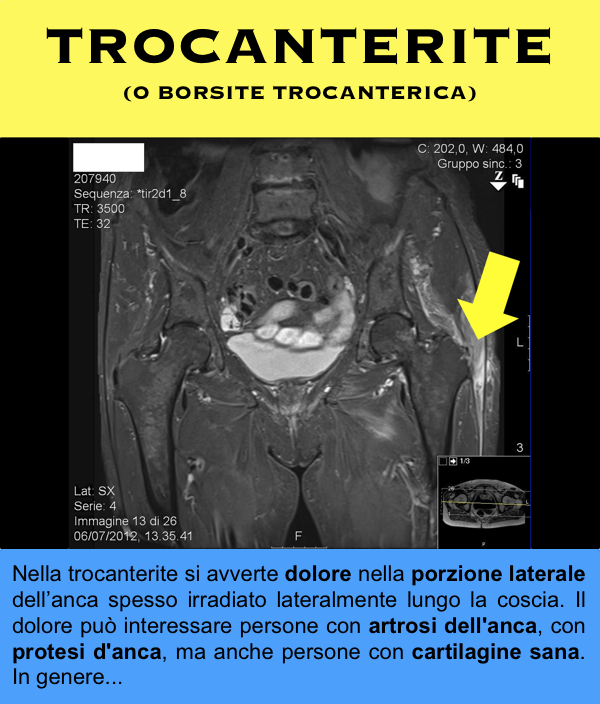 Trocanterite anca dolore artrosi protesi link