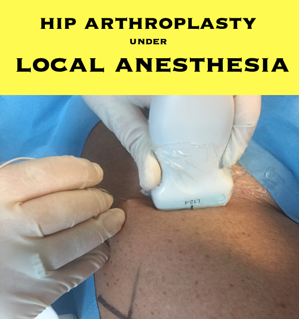 hip arthroplasty under local anesthesia 